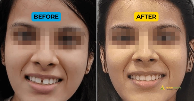 Traditional Metal Braces in Gurgaon: 2025 Prices, Pros & Treatment Timeline