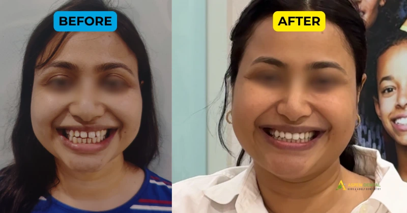 Invisalign Cost in Gurgaon: 2025 Price Breakdown & EMI Tips