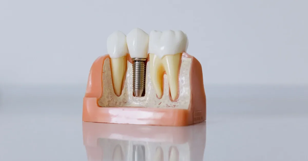 Close-up model showing a dental implant post placed between natural teeth