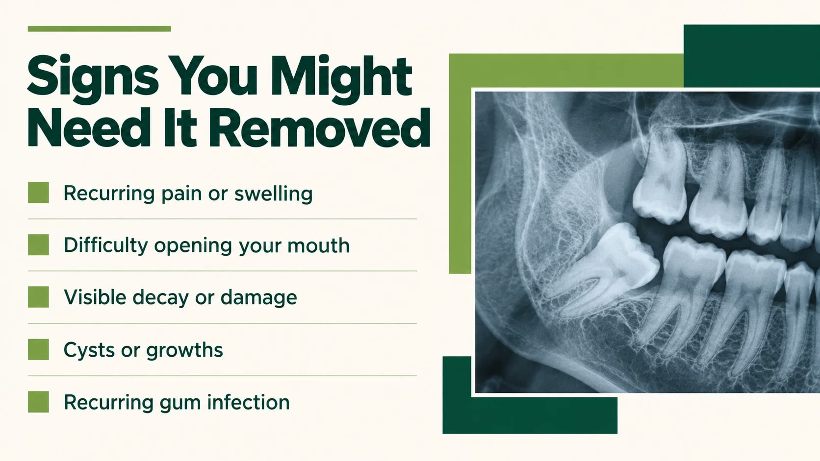 Signs a wisdom tooth may need to be removed