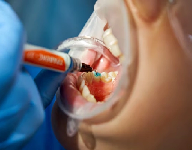 Pit and Fissure Sealants