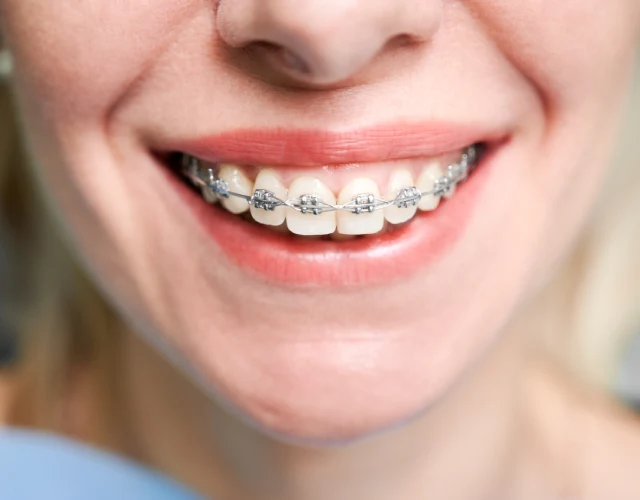 Traditional Metal Braces in Gurgaon