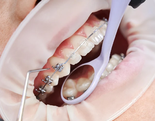 Damon Self-Ligating Braces