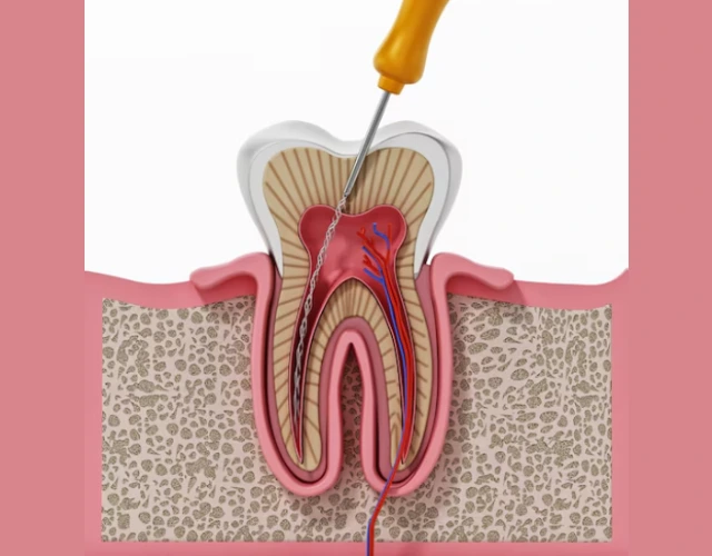 Root Canal Treatment (RCT)