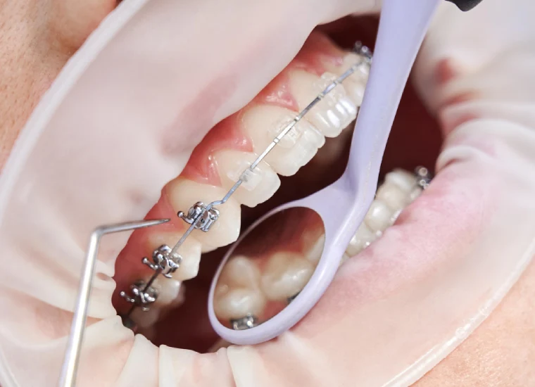 Damon Self-Ligating Braces in Gurgaon – Faster, Comfortable, and Advanced Orthodontics