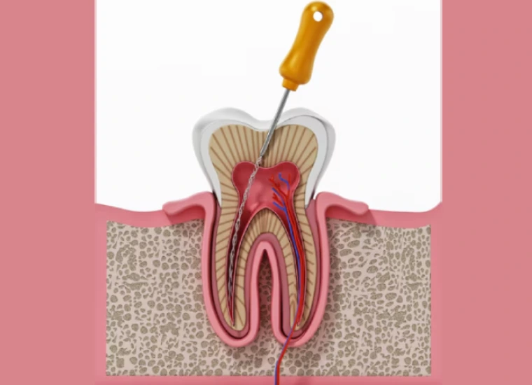 Root Canal Treatment (RCT) in Gurgaon