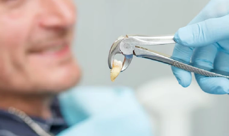 Tooth Extractions in Gurgaon