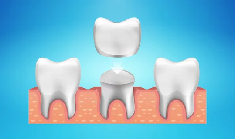 Dental Crowns in Gurgaon