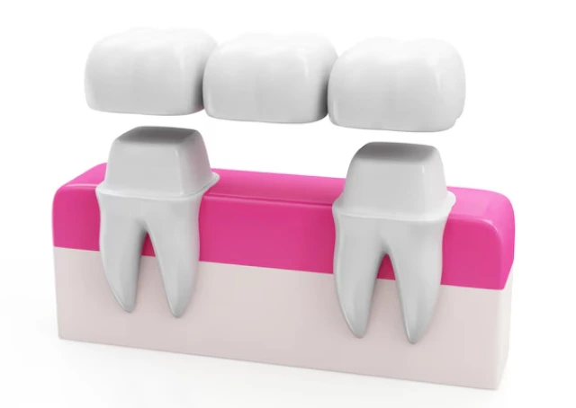 Dental Bridge in Gurgaon
