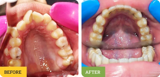 Invisalign Smile Transformation