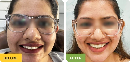 Damon Braces Smile Correction