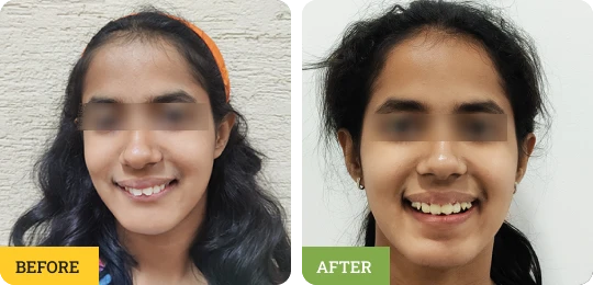 Teeth Crowding Correction