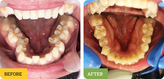 Deep Bite Correction