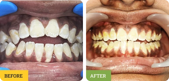 Open Bite Correction