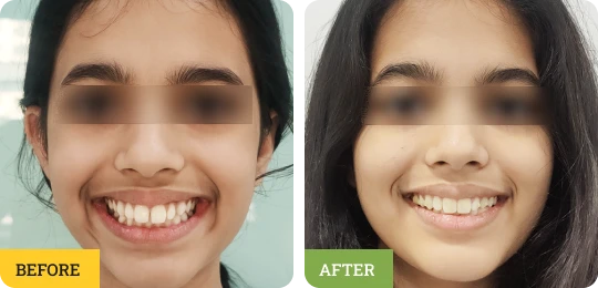 Invisalign Smile Alignment