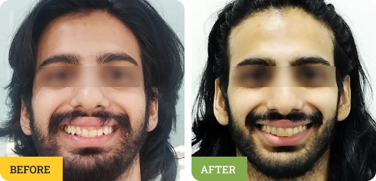 Deep Bite Correction