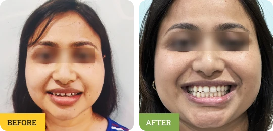 Teeth Spacing Treatment