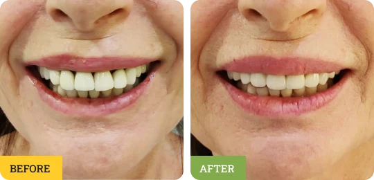 Full Mouth Rehabilitation