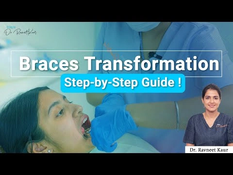 How dentist put braces on teeth | Braces treatment | Orthodontist in gurgaon